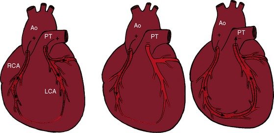 Common Symptoms of Neonatal Anomalous Left Coronary Artery from the Pulmonary Artery (ALCAPA)