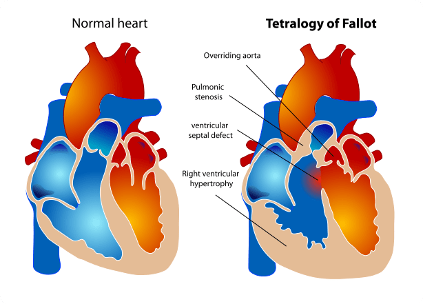 Common Symptoms of Neonatal Tetralogy of Fallot with Absent Pulmonary Valve