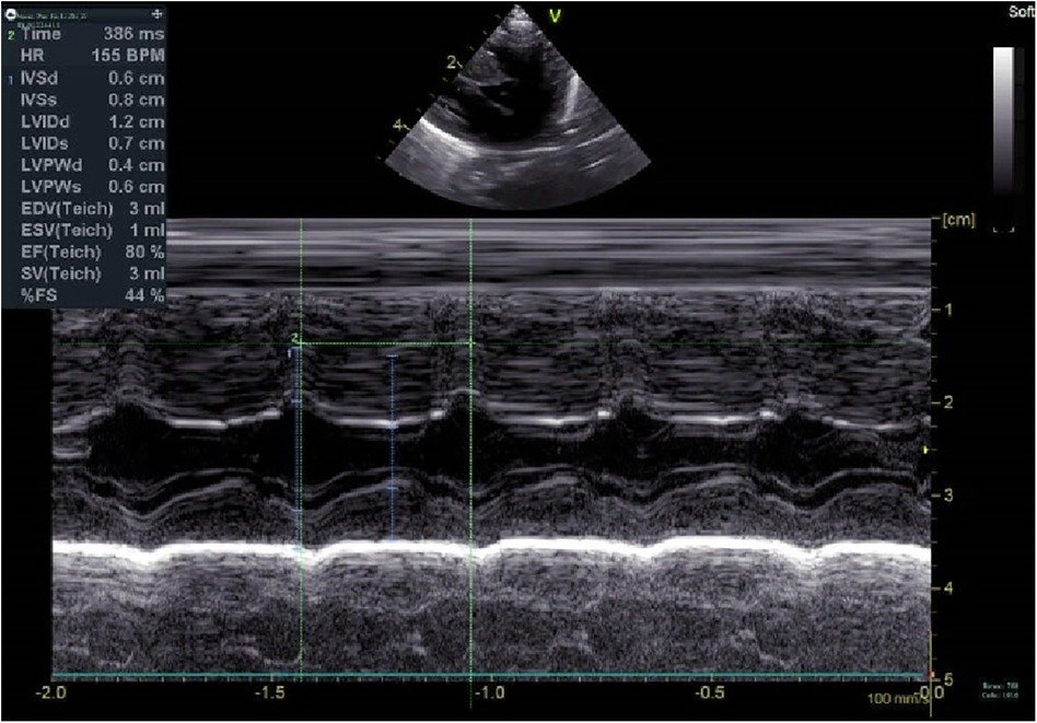Common Symptoms of Neonatal Hypertrophic Cardiomyopathy