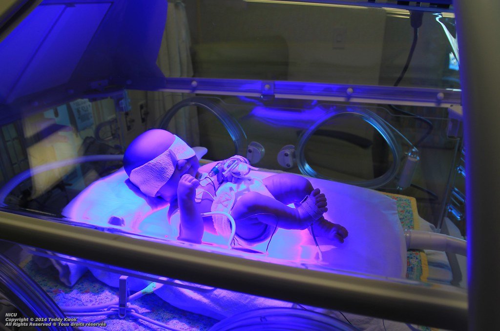 Symptoms of Neonatal Hyperbilirubinemia (Jaundice)