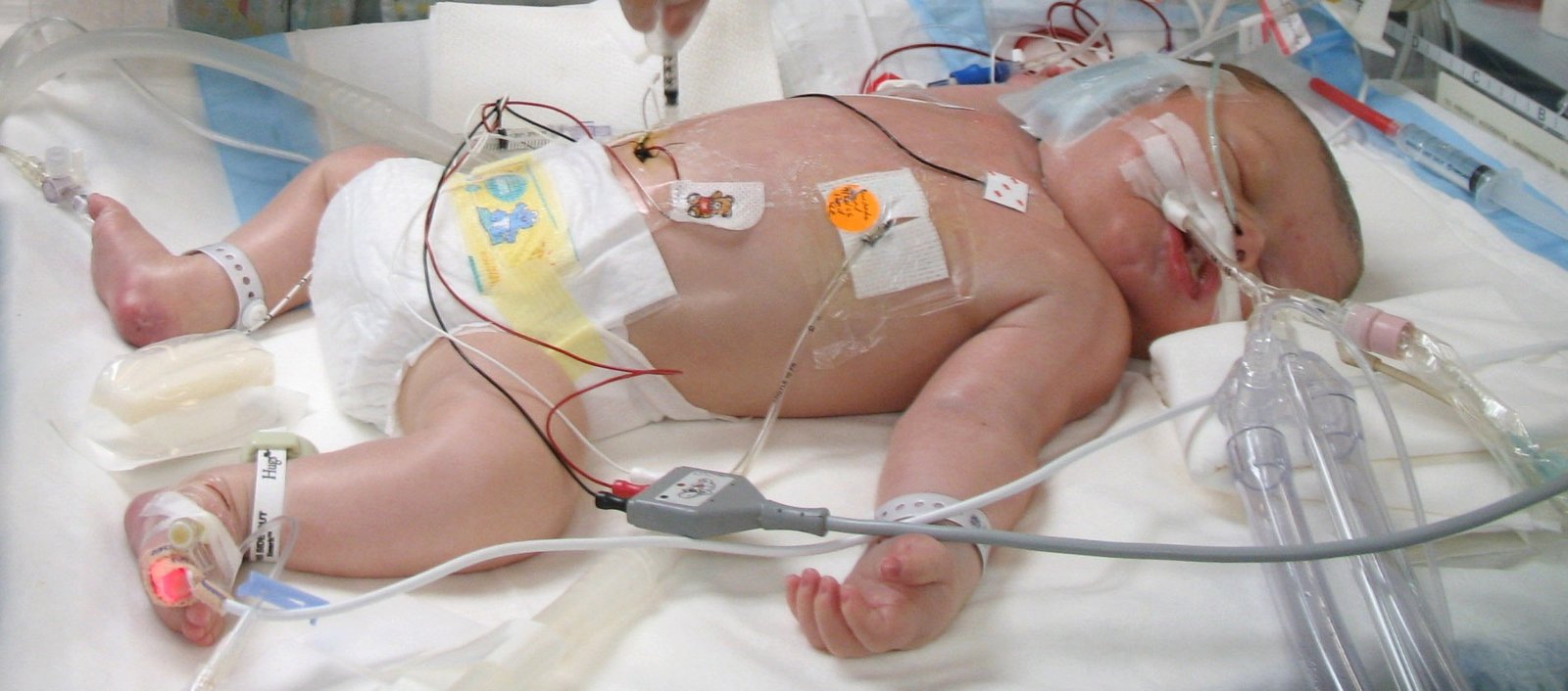 Common Symptoms of Neonatal Respiratory Distress Syndrome