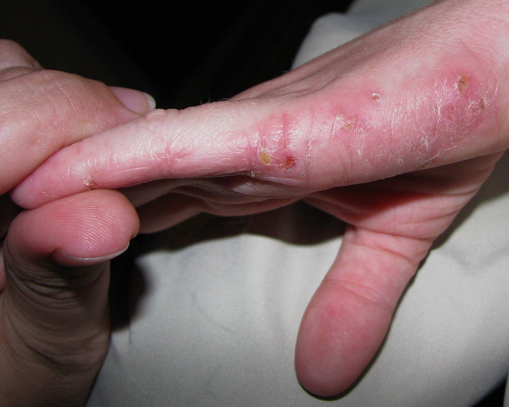 Symptoms of Eczema: Understanding the Skin Condition