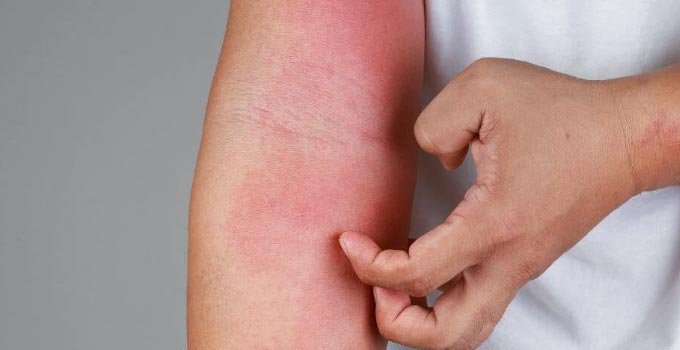 Allergies or a Cold? Recognizing the Symptoms