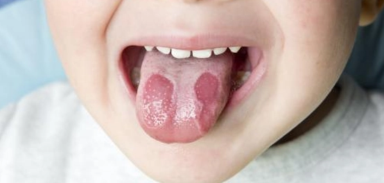 أسباب التهابات اللسان وطرق العلاج المنزلية