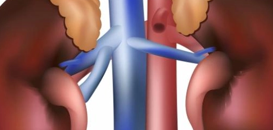 التهاب الكلى: الأسباب، الأعراض، التشخيص، والعلاج