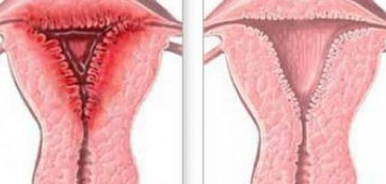 التهابات الرحم: الأسباب، العلاج، والوقاية