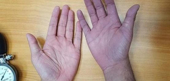 زرقة راحتي اليدين: الأسباب، التشخيص، ومتى يجب زيارة الطبيب