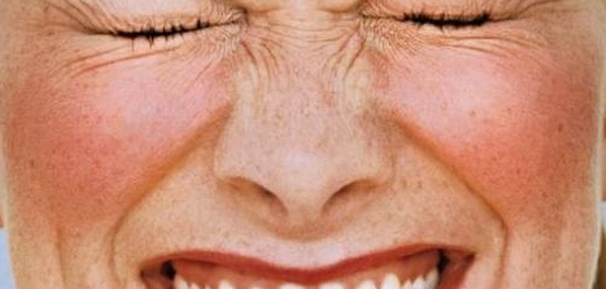 احمرار الوجه: الأسباب، العلاج، والوقاية