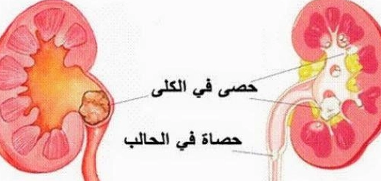 حصوات الكلى: الأسباب، الأعراض، التشخيص، والعلاج