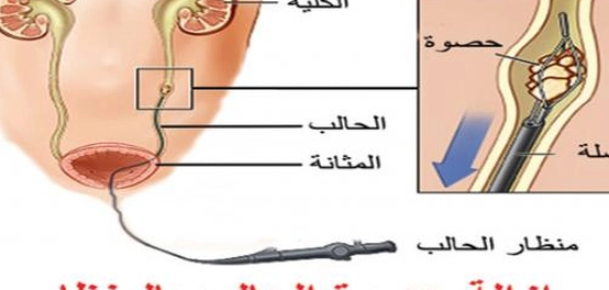 حصوات الحالب: الأسباب، الأعراض، العلاج، والوقاية
