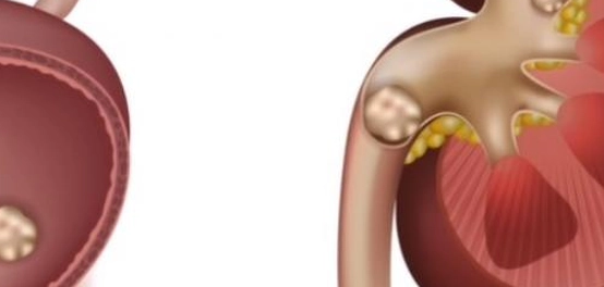 حصوات الحالب: الأعراض، التشخيص، والعلاج