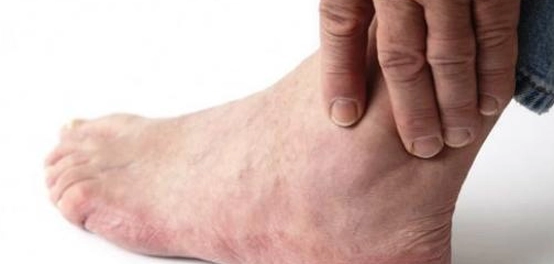أسباب ارتفاع حمض اليوريك وطرق علاجه