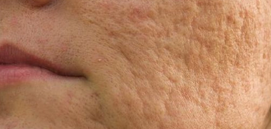 علاج ندوب الوجه: أسبابها و طرق التخلص منها