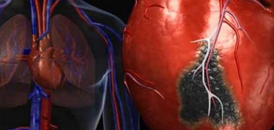 مخاطر الجلطة القلبية: الأسباب، الأعراض، والإسعافات الأولية