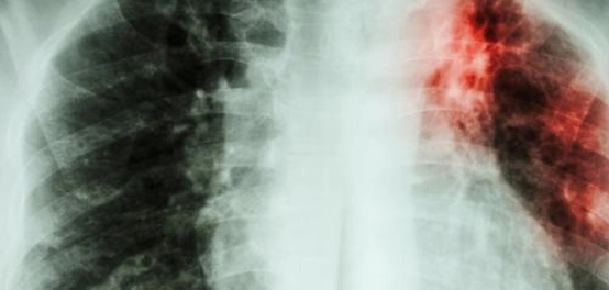 أسباب تليف الرئة: دليل شامل للعوامل والوقاية