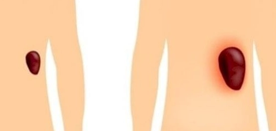 أسباب تضخم الطحال: دليل شامل