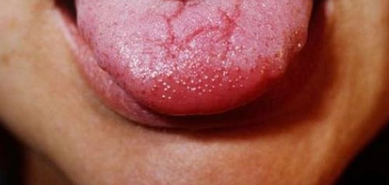 علاج وتشخيص تشققات اللسان