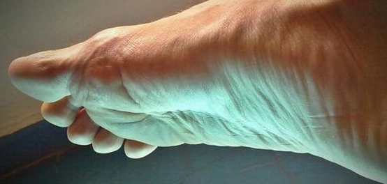 أسباب الوخز في الأطراف