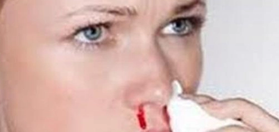 نزيف الأنف: الأسباب والعلاج