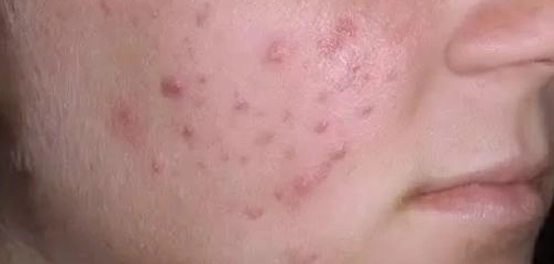 ظهور الحبوب الصغيرة على الوجه: الأسباب والعلاج