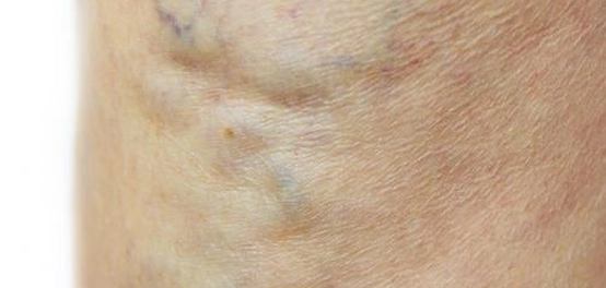 دوالي الساقين خلال الحمل: الأسباب، المخاطر، الوقاية، والعلاج