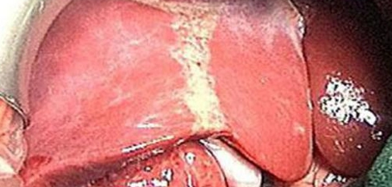 تراكم الدهون في الكبد وارتفاع إنزيماته: الأسباب، الأعراض، والعلاج