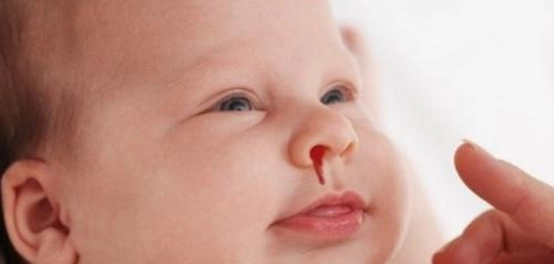 نزيف الأنف المتكرر: الأسباب والعلاج