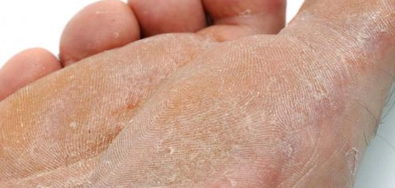 فطريات القدم: الأسباب، عوامل الخطر، وطرق الوقاية