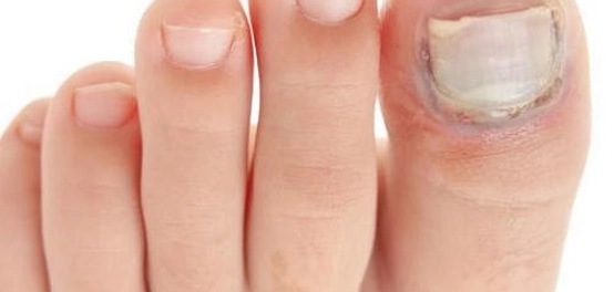 أسباب وعلاج فطريات الأظافر