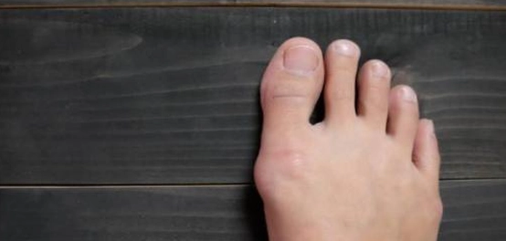 أسباب بروز عظمة الإبهام