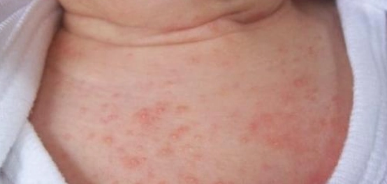 ظهور البثور الجلدية عند الأطفال: الأسباب والعلاج