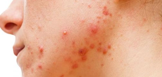 الحبوب والرؤوس السوداء: الأسباب والعلاجات