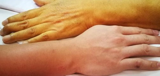 اليرقان: أسباب اصفرار الجلد وأعراضه وطرق تشخيصه