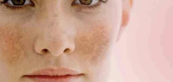 فهم أسباب ظهور الكلف وطرق علاجه