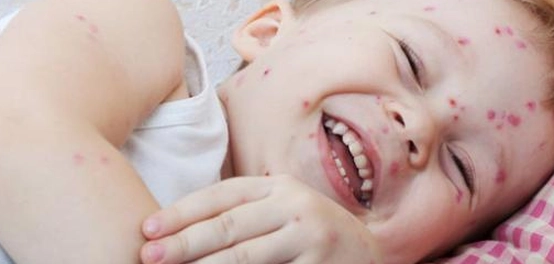 حبوب الوجه عند الأطفال: الأسباب والعلاج