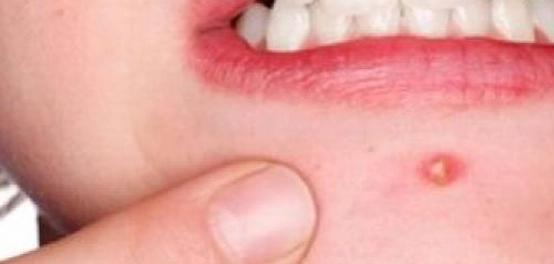 ظهور البثور الحمراء: الأسباب والعلاج