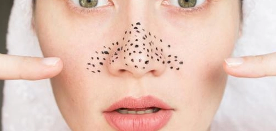 سلبيات استخدام لصاقات إزالة الرؤوس السوداء