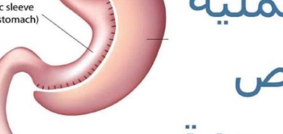 جراحة تكميم المعدة: الفوائد والمخاطر المحتملة