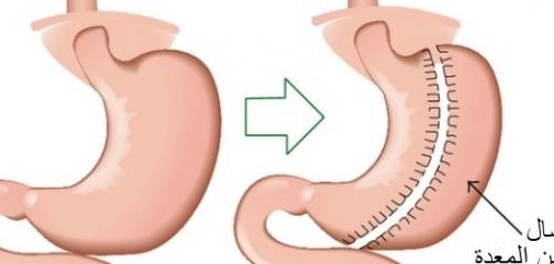 مخاطر جراحة تكميم المعدة: دليل شامل للمضاعفات المحتملة