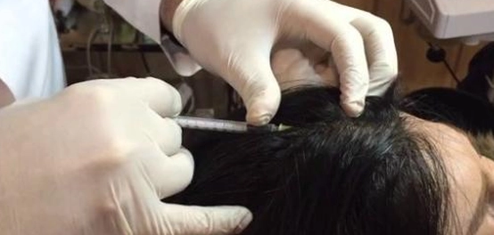 عيوب حقن الميزوثيرابي للشعر: ما يجب معرفته قبل العلاج