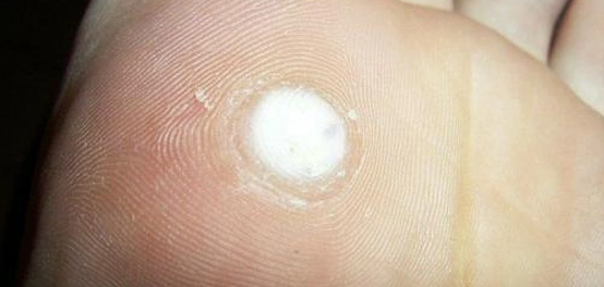 طرق فعّالة للتخلص من الثآليل