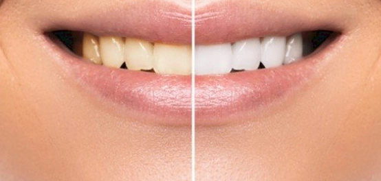 أسرار الحصول على ابتسامة بيضاء ساحرة