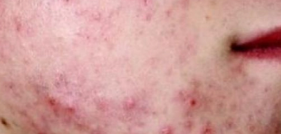 علاج فعال لحب الشباب: دليل شامل