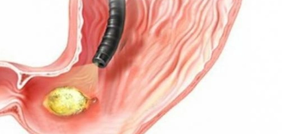 علامات قرحة المعدة والاثنى عشر: دليل شامل