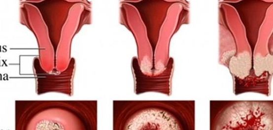 التهاب عنق الرحم: الأعراض، العلاج، والأسباب