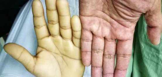 دليل شامل لأعراض فقر الدم وأنواعه