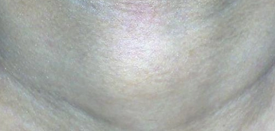 دليل شامل لأعراض سرطان الغدة الدرقية