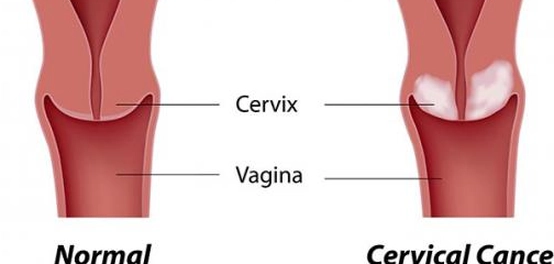 علامات سرطان الرحم: دليل شامل