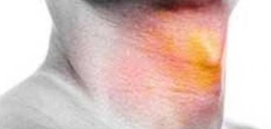 علامات سرطان الحنجرة: دليل شامل