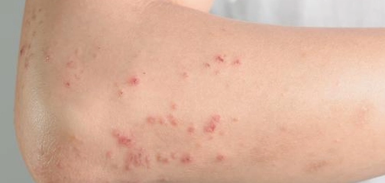 علامات الحساسية الجلدية: دليل شامل
